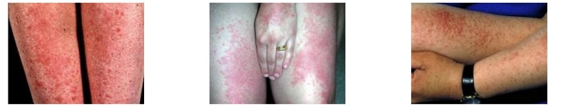 Пятна на коже при аллергии на солнце thumbnail