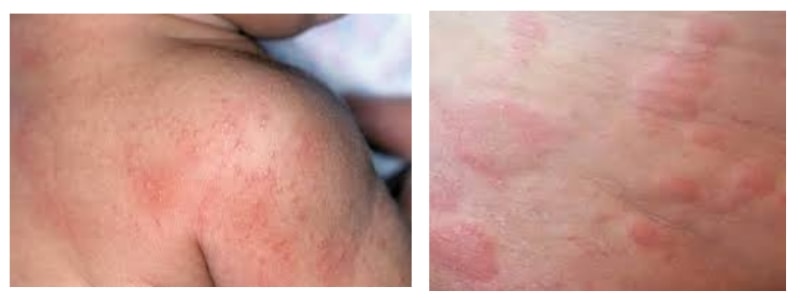 Аллергия на солнце: пятна на коже и не только