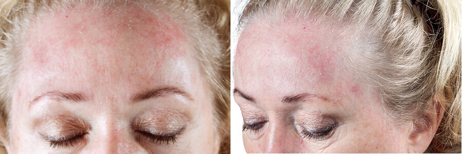 Себорея кожи головы - причины и лечение