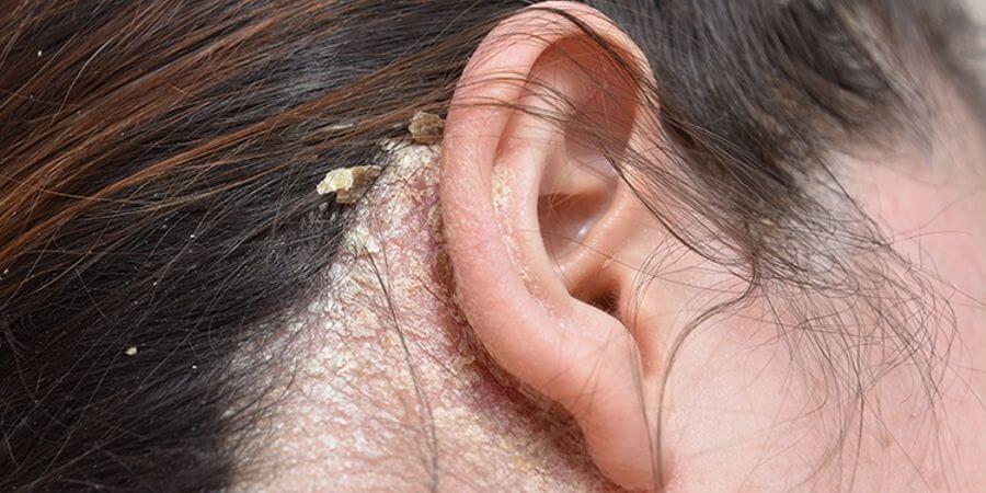 Себорея кожи головы - причины и лечение