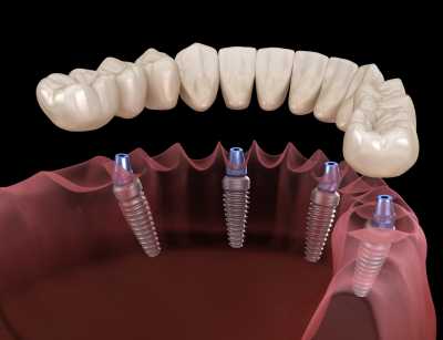 Методики и технологии протезирования зубов