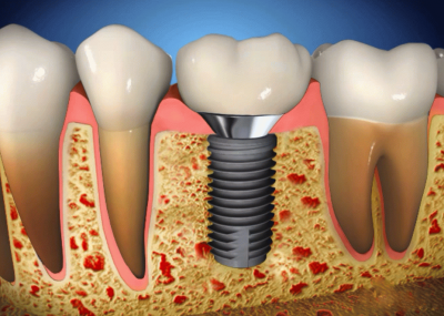 Правила установки зубных имплантов