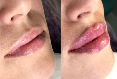 Булхорн — пластика губ, которая их сделает пухлыми и выразительными