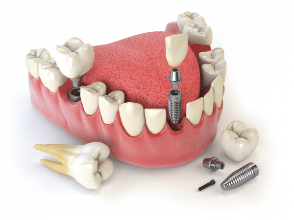 Что подразумевает одномоментная имплантация зубов
