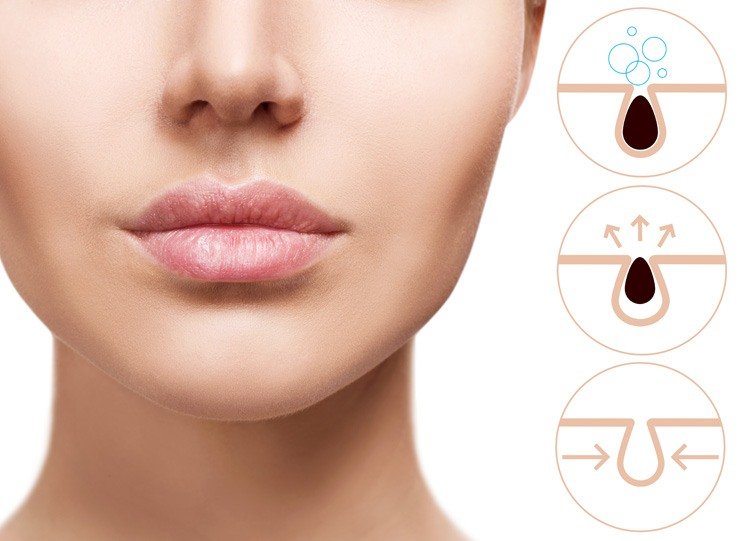 Средства от черных точек на носу: рейтинг 14 лучших косметических продуктов